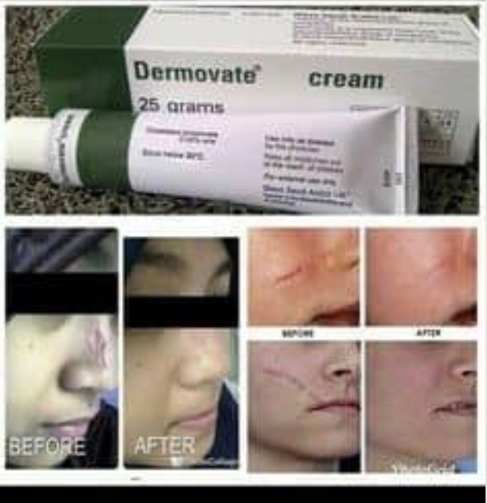 Dermovate Cream